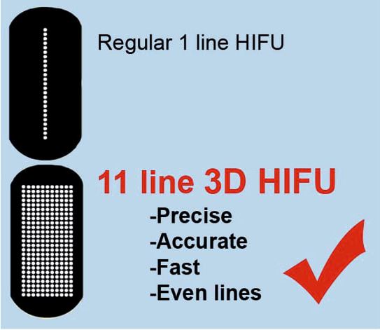 Tratamiento HIFU 3D en WAM Center | Clínica Estética: tecnología avanzada para rejuvenecimiento facial y corporal.