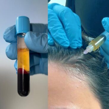 Paciente recibiendo tratamiento de PRP capilar en WAM Center | Clínica Estética para mejorar el crecimiento del cabello.