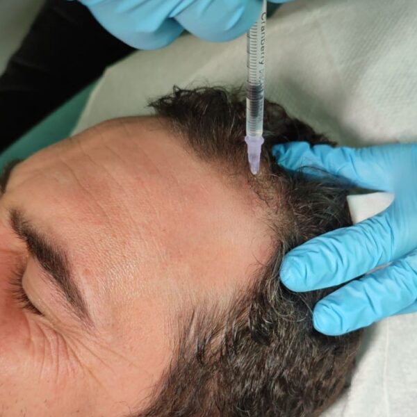 Tratamiento anticaída del cabello en WAM Center | Clínica Estética: restauración capilar experta y resultados visibles.