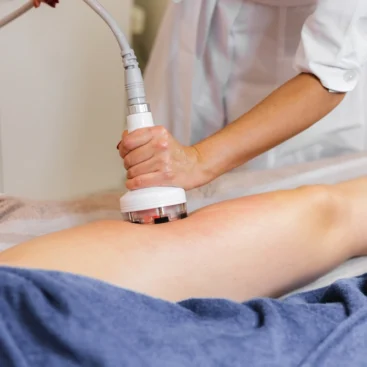 Aplicación de tratamiento anticelulitis edematosa en piernas femeninas