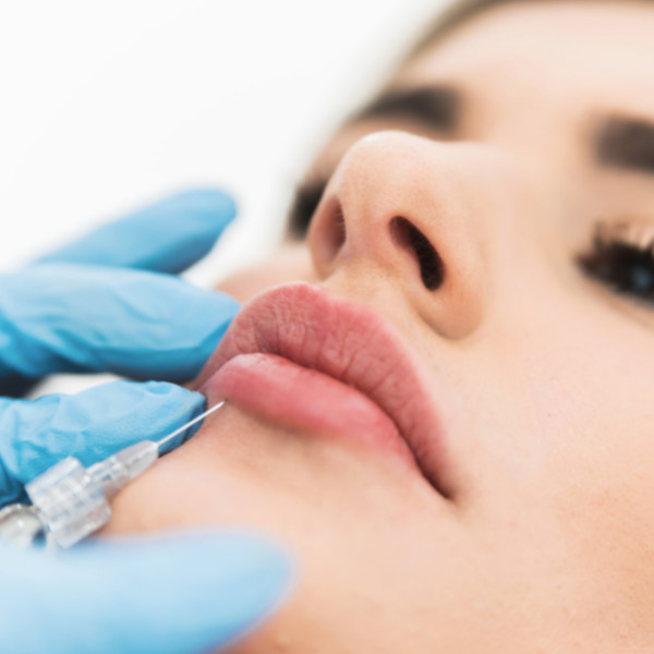 7 Relleno de labios- acido hialurónico