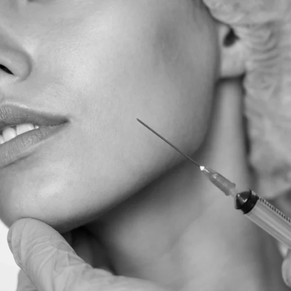Reducción de papada sin cirugía en rostro femenino