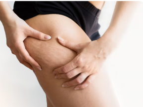 Tratamiento celulitis fibrosa